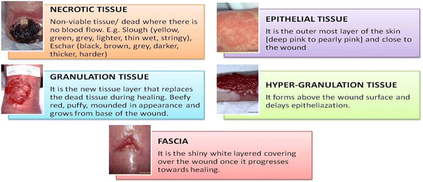 Different Tissue Types Present In Chronic Wounds Download Scientific Different Tissue Types Present In Chronic Wounds Download Scientific