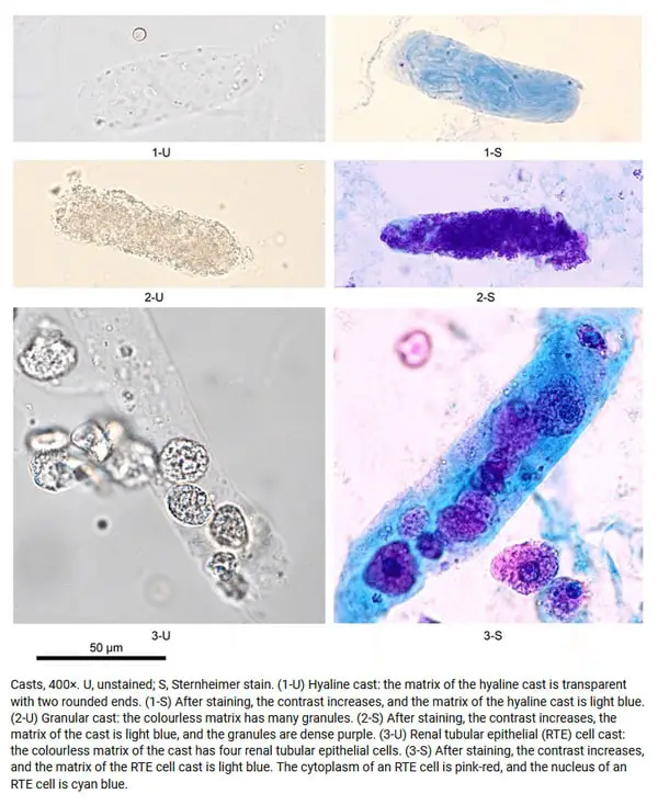 Understanding Elevated Hyaline Casts in Urine: Causes & Concerns