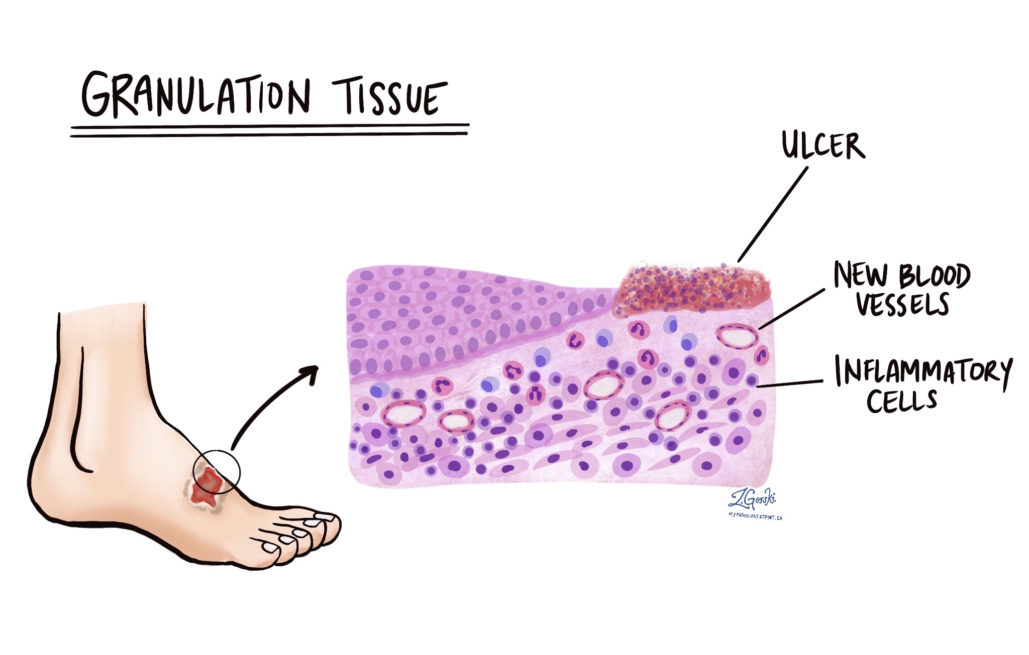 Figure 1 From A Case Of Granulation Tissue Of The Tongue In Infant Figure 1 From A Case Of Granulation Tissue Of The Tongue In Infant