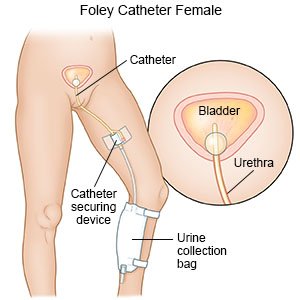 Foley Catheter Placement for Females: A Step-by-Step Guide