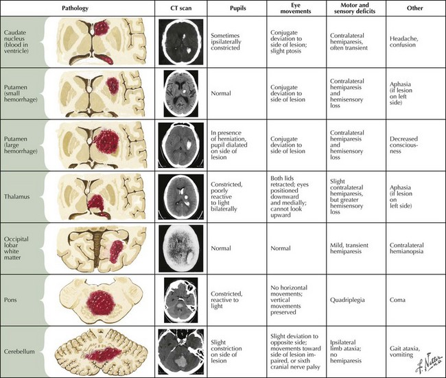 Prevent Intracranial Bleeding: Essential Exercises to Stay Safe