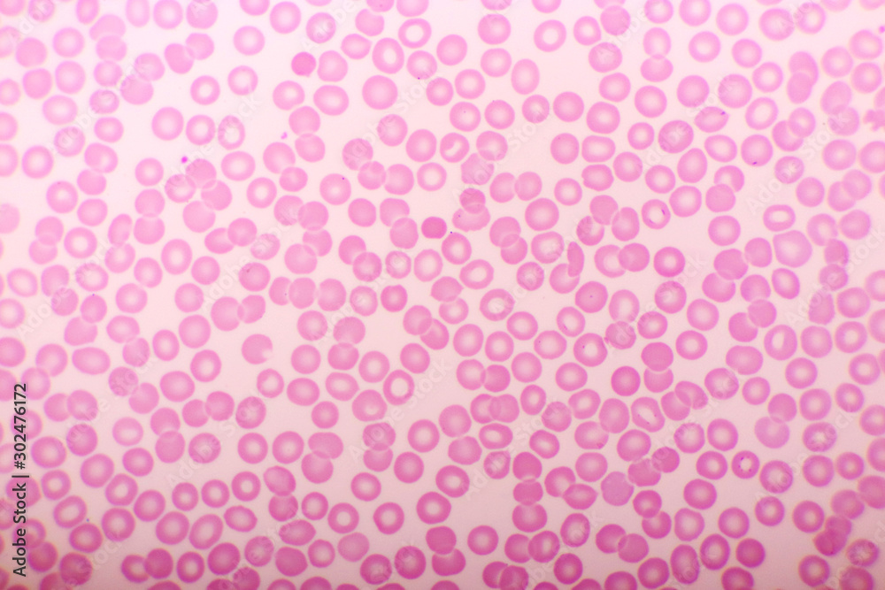 Leukemia Human Blood Cell Under Microscope 1000X Stock Photo Leukemia Human Blood Cell Under Microscope 1000X Stock Photo