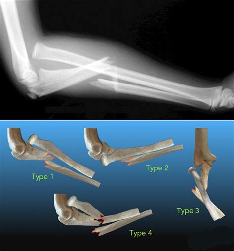 Monteggia Fracture Pictures Symptoms Causes Diagnosis Monteggia Fracture Pictures Symptoms Causes Diagnosis